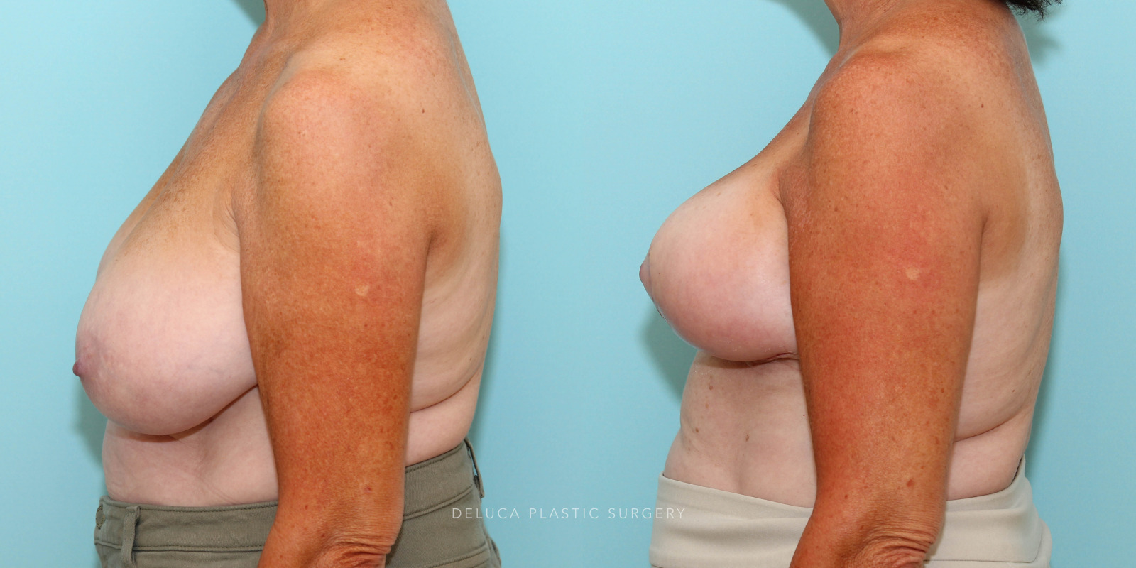 65 year old Superior Pedicle, Wise Pattern Breast Reduction