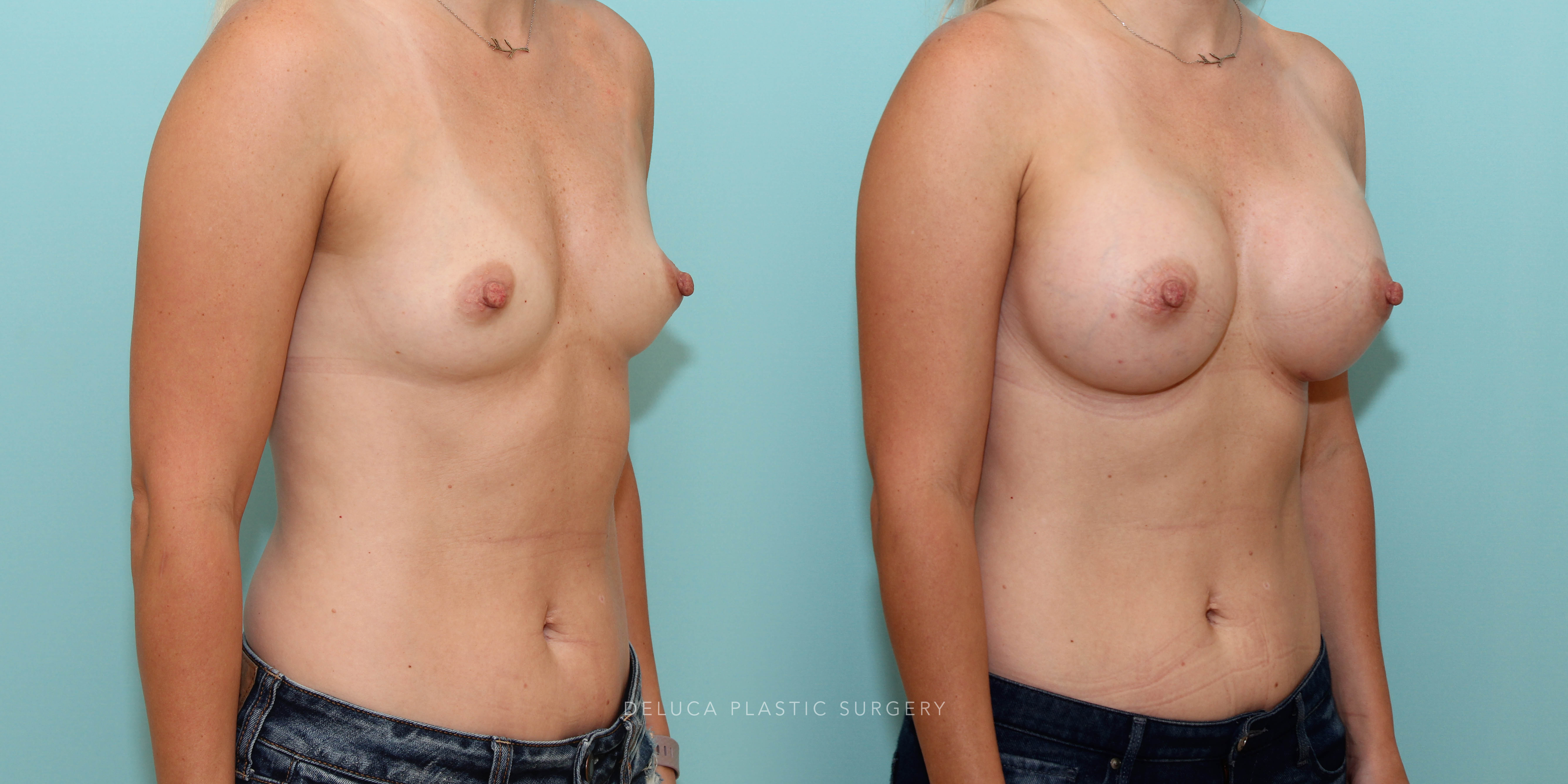 Augmentation with a 425cc moderate plus smooth silicone implant