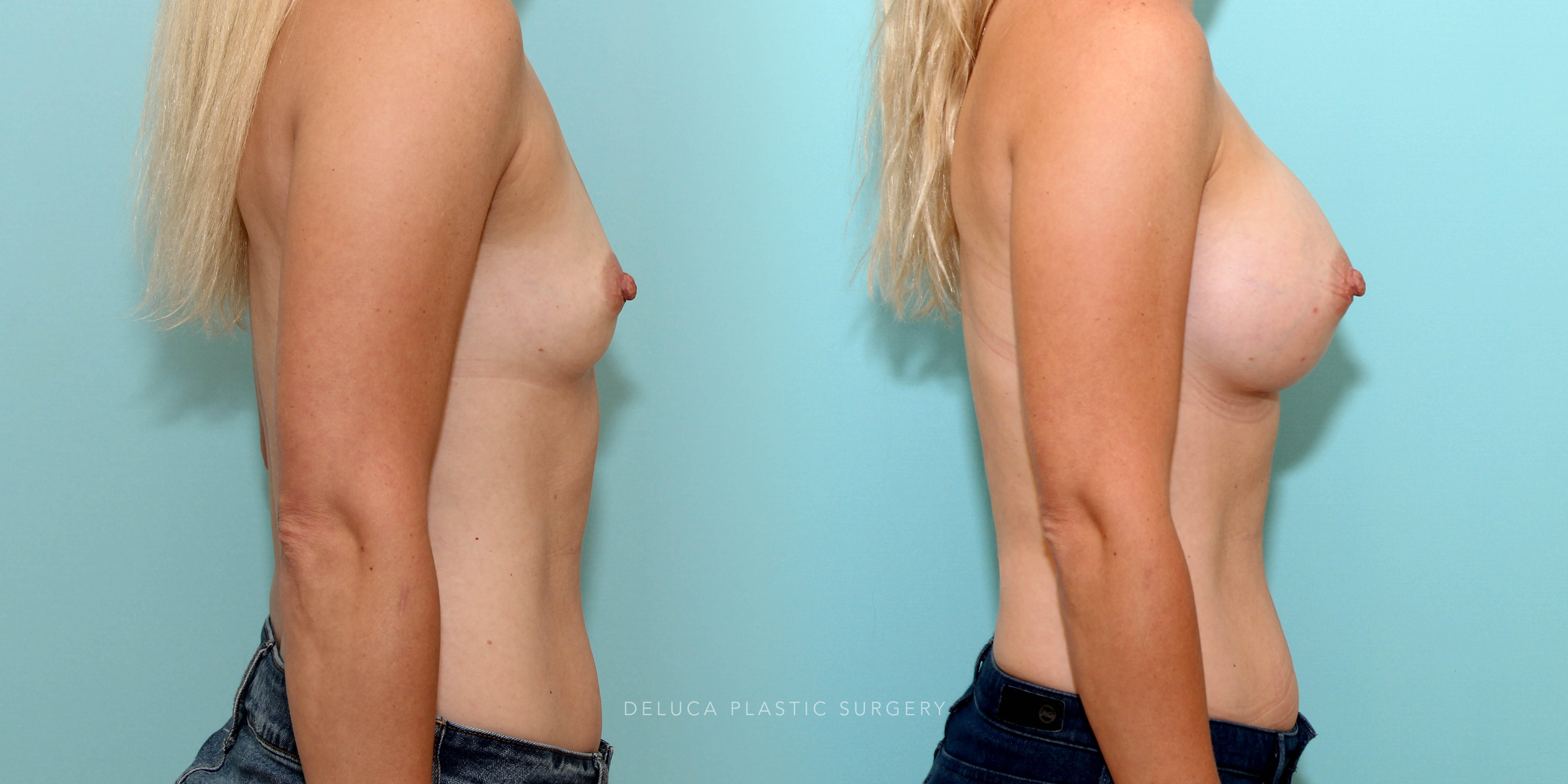 Augmentation with a 425cc moderate plus smooth silicone implant