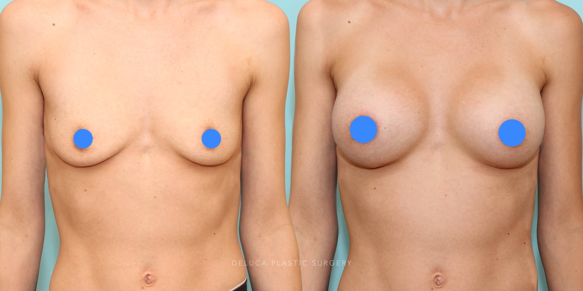 Breast augmentation before and after showing improved breast volume, shape, and proportion