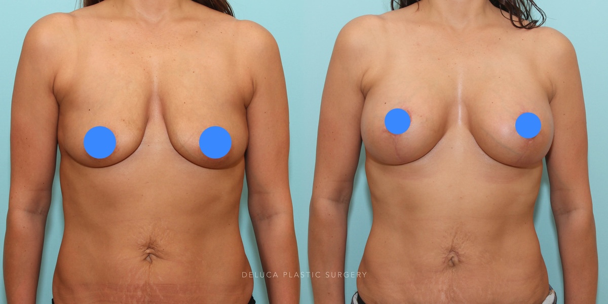 Breast lift with implants before and after showing improved breast position, volume, and proportion