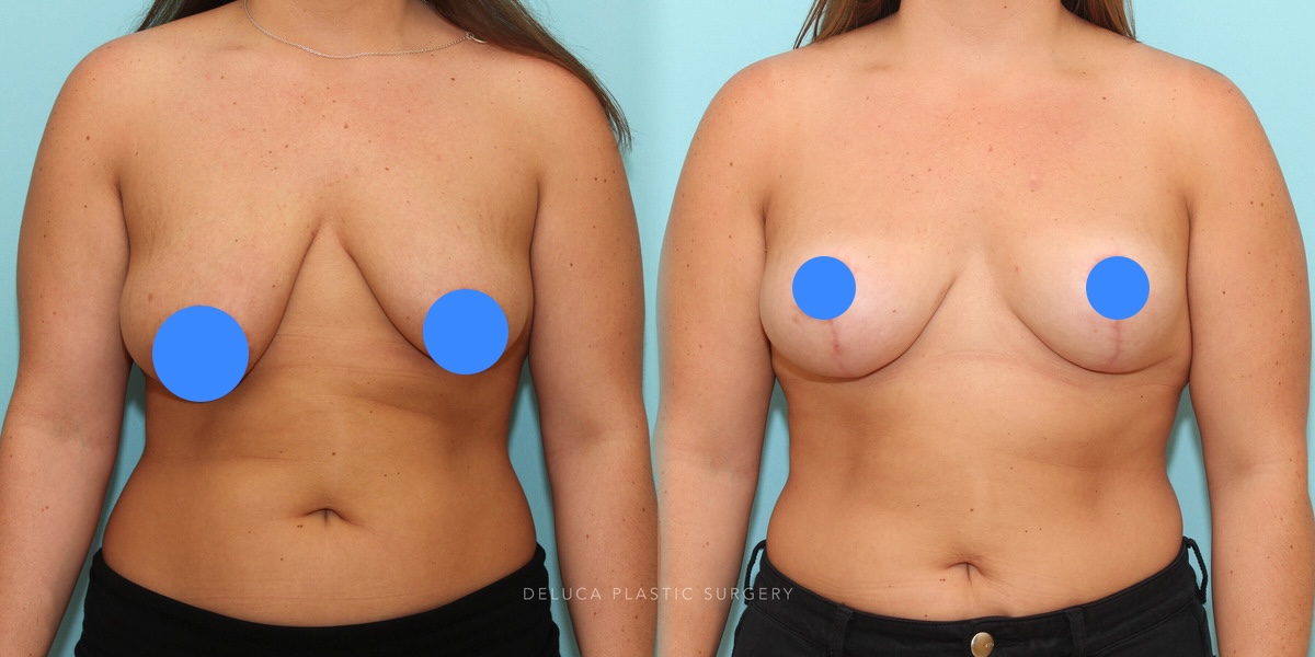 Breast lift before and after showing improved breast position, nipple placement, and natural breast shape
