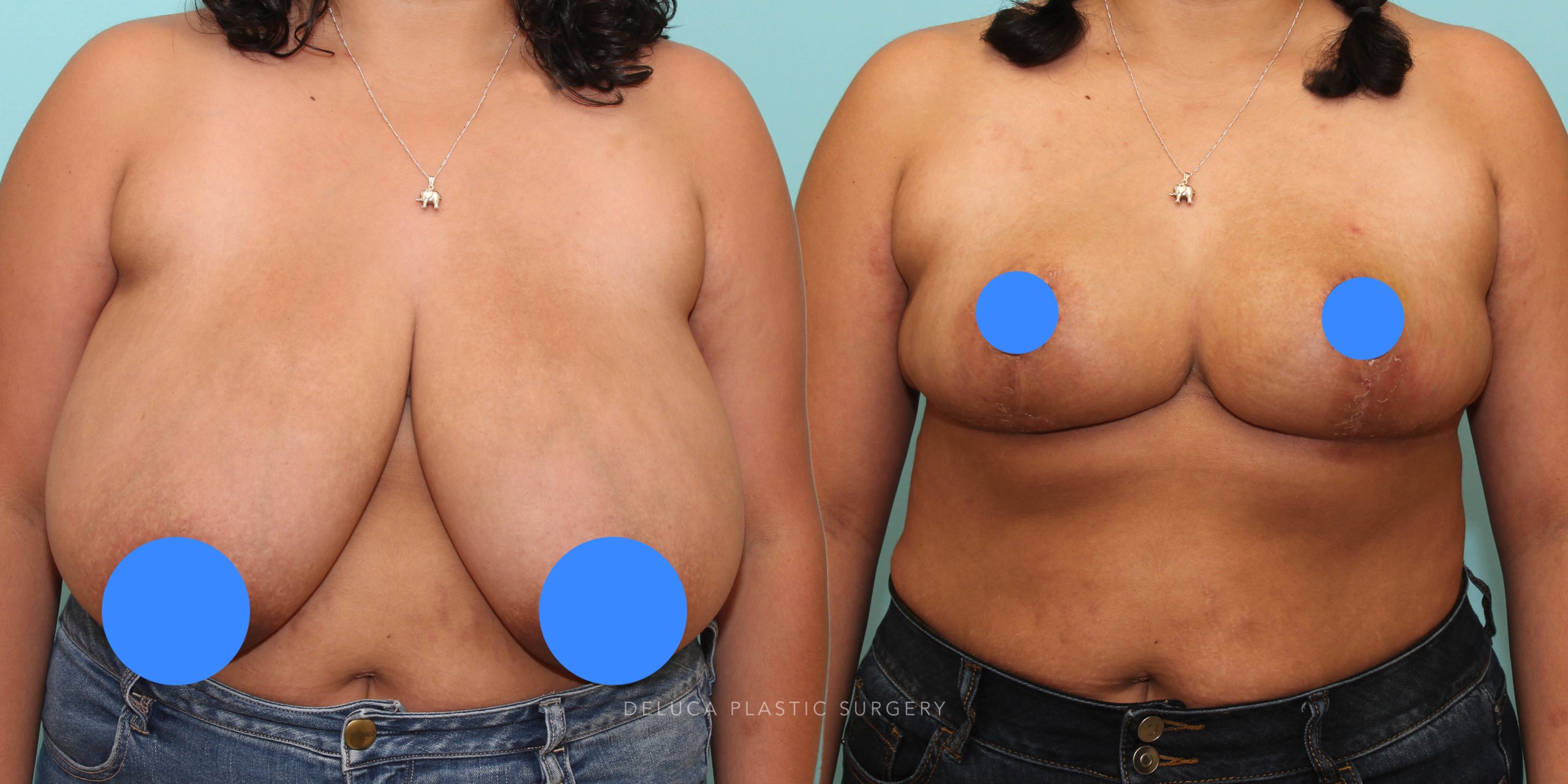 Breast reduction before and after showing smaller, lifted, more proportional breast shape