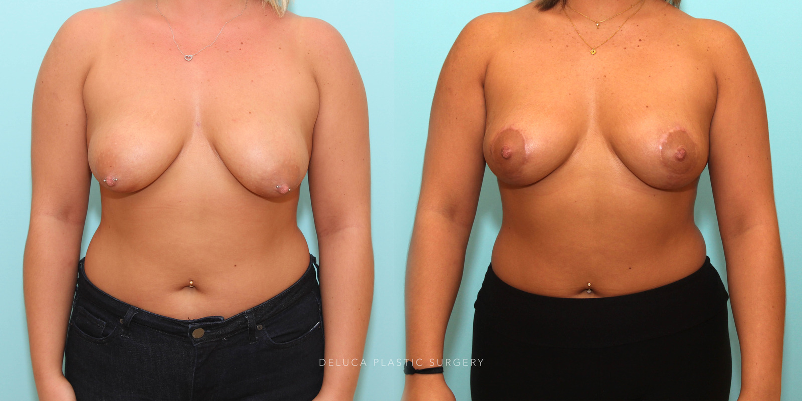 20 Year Old Circumvertical (Lollipop) Breast Lift