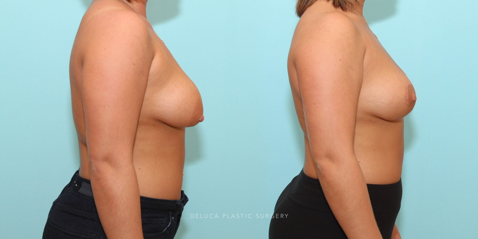 20 Year Old Circumvertical (Lollipop) Breast Lift