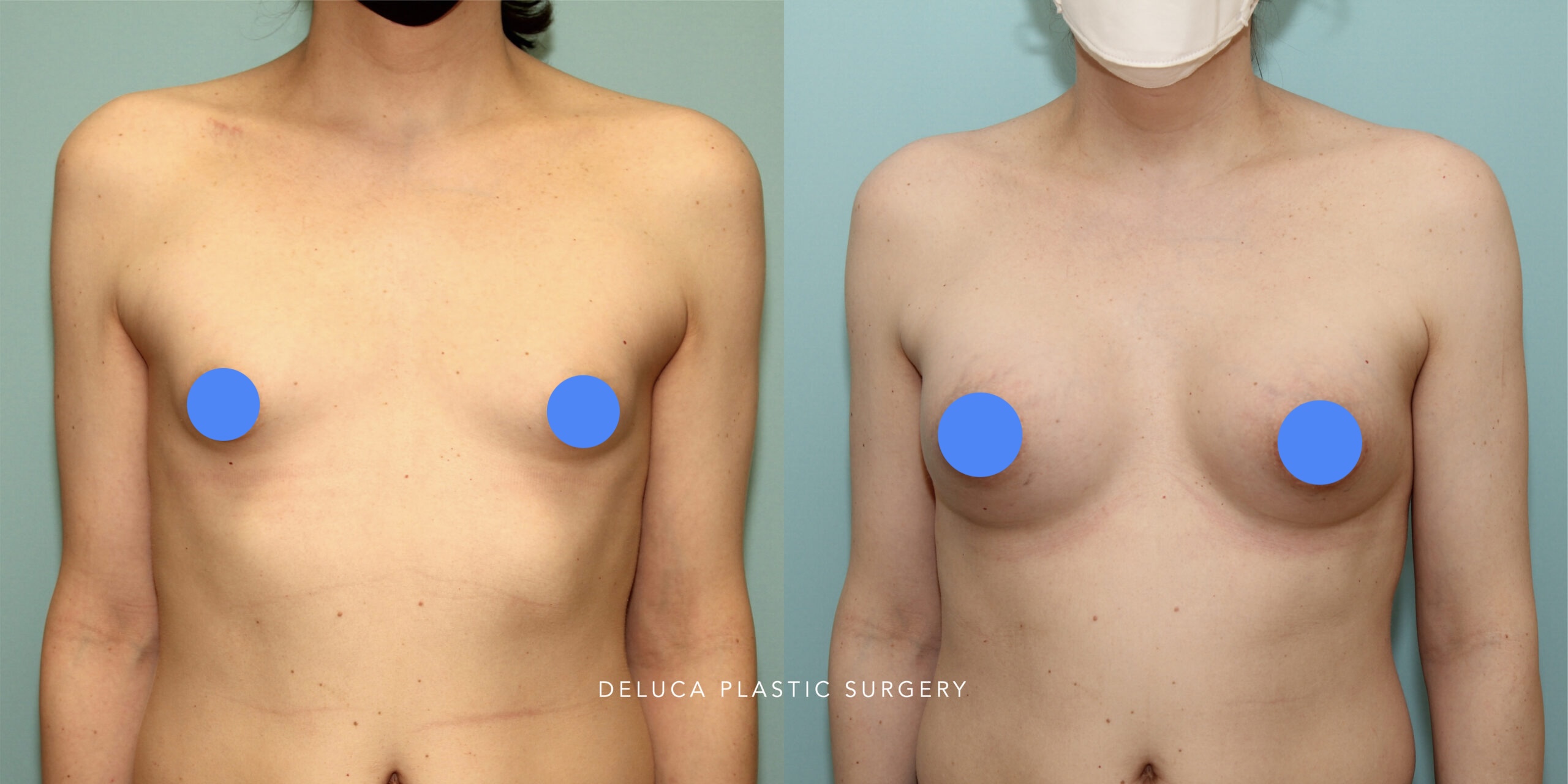 Transgender top surgery before and after showing chest contour improvement