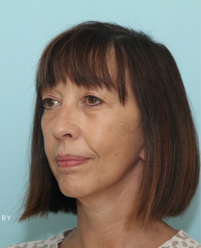 After natural face and neck rejuvenation result