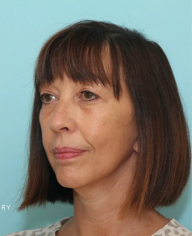 After natural face and neck rejuvenation result