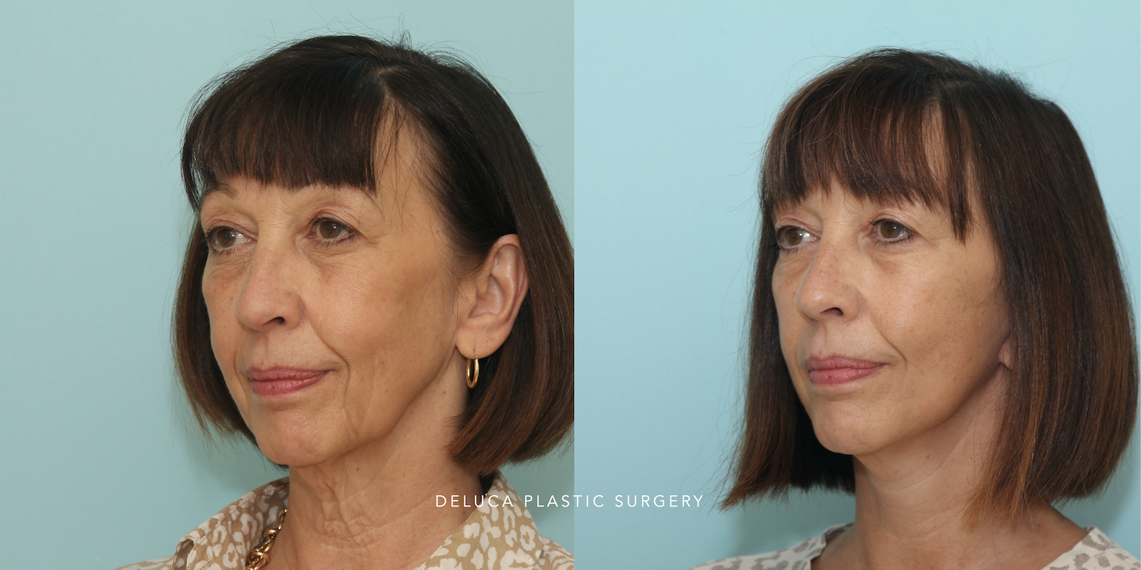 Facelift before and after showing improved jawline, neck contour, and facial balance