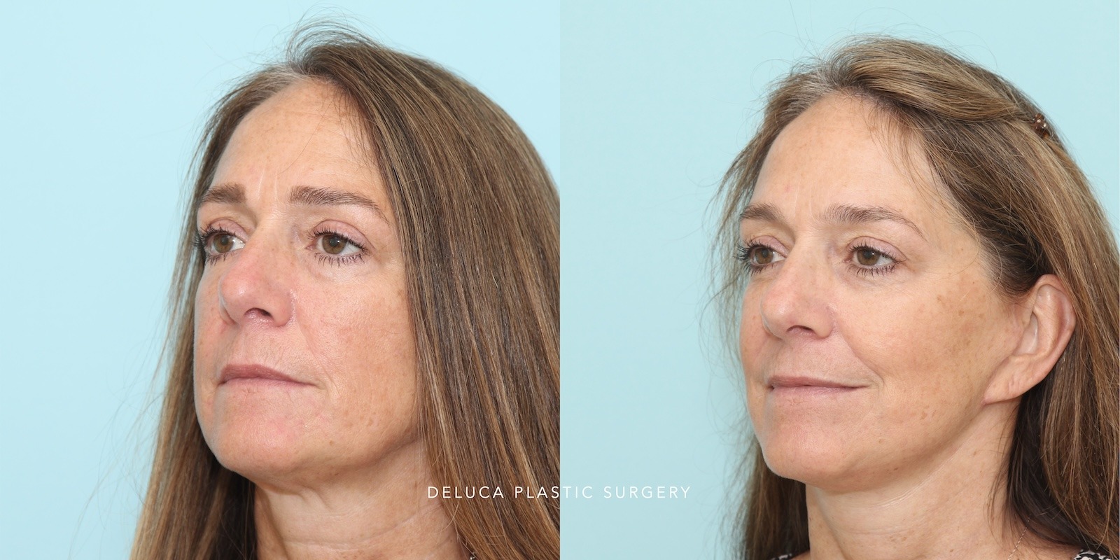 Soft clinical preview image representing facial procedure results