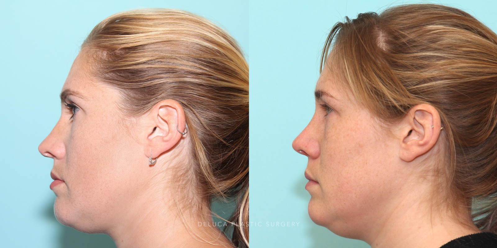 27 year old Rhinoplasty