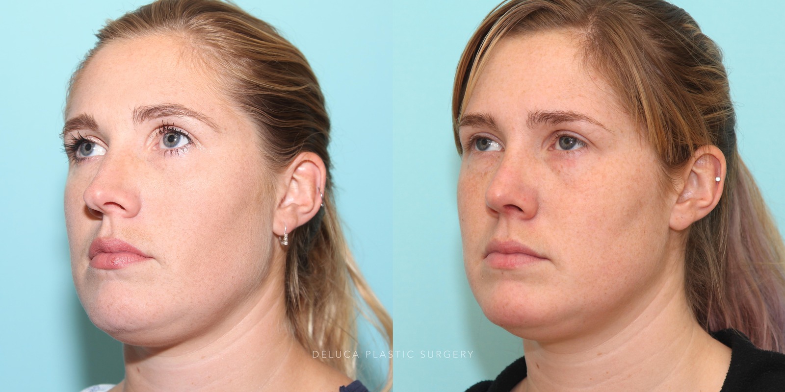 27 year old Rhinoplasty