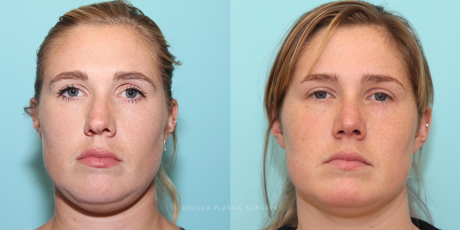 27 year old Rhinoplasty