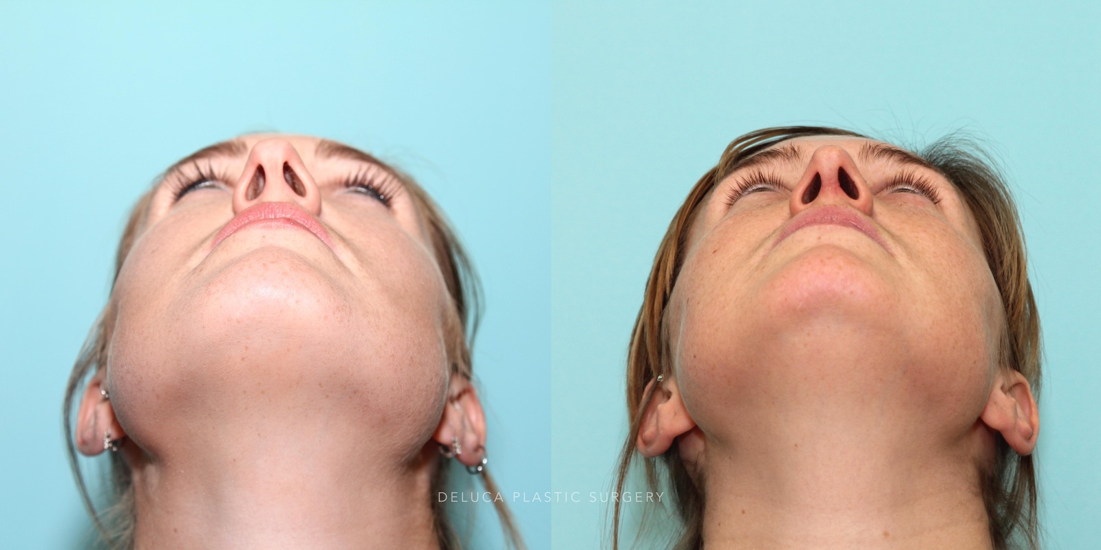 27 year old Rhinoplasty