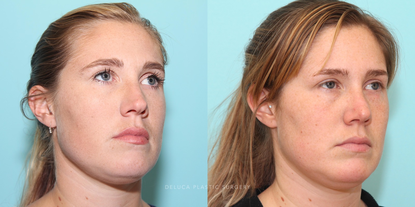 27 year old Rhinoplasty