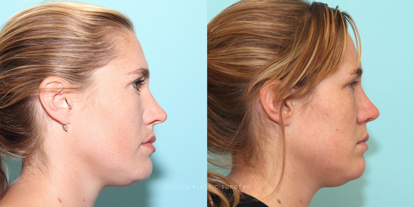 27 year old Rhinoplasty