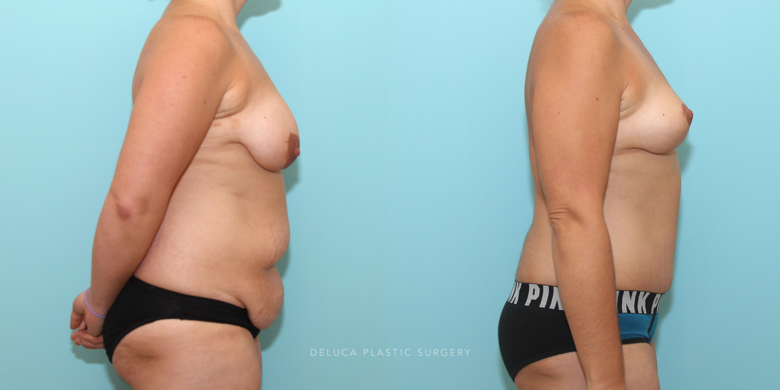36 year old Mommy Makeover - Breast Lift (Mastopexy) and Tummy Tuck (Abdominoplasty)