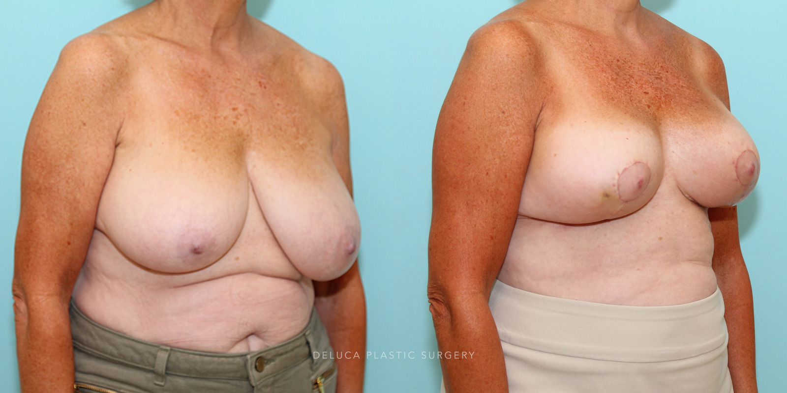 65 year old Superior Pedicle, Wise Pattern Breast Reduction