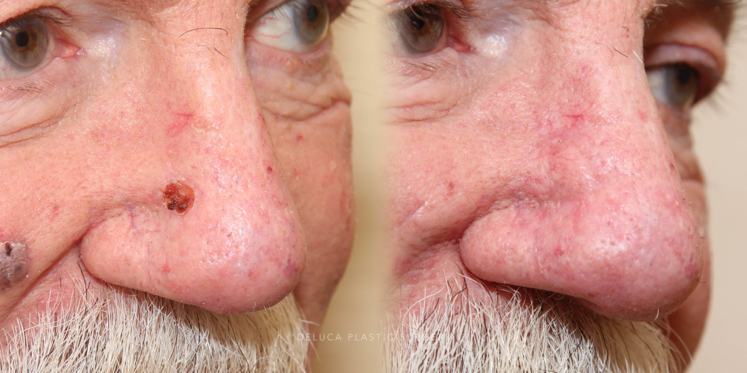 Skin Cancer Removal and Reconstruction on The Nose