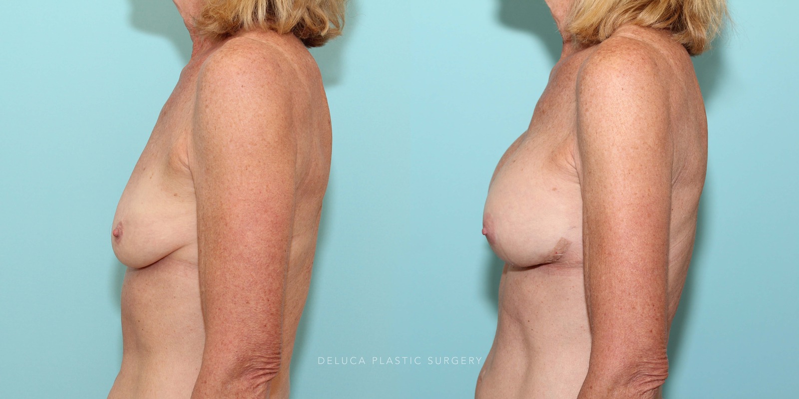61 Year Old Secondary Asymmetric Breast Augmentation Silicone Implants