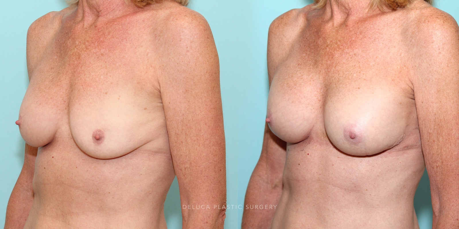 61 Year Old Secondary Asymmetric Breast Augmentation Silicone Implants