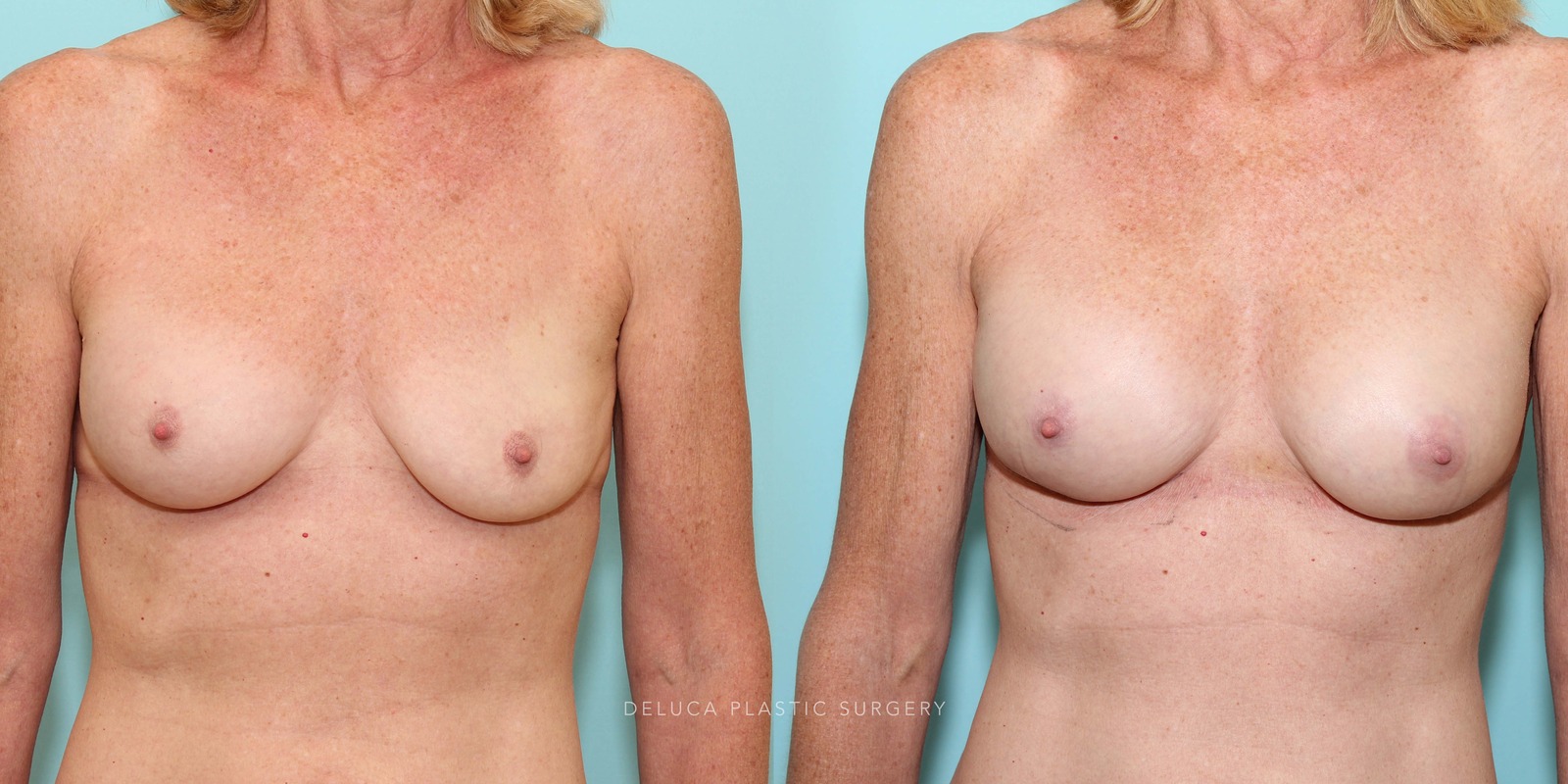 61 Year Old Secondary Asymmetric Breast Augmentation Silicone Implants