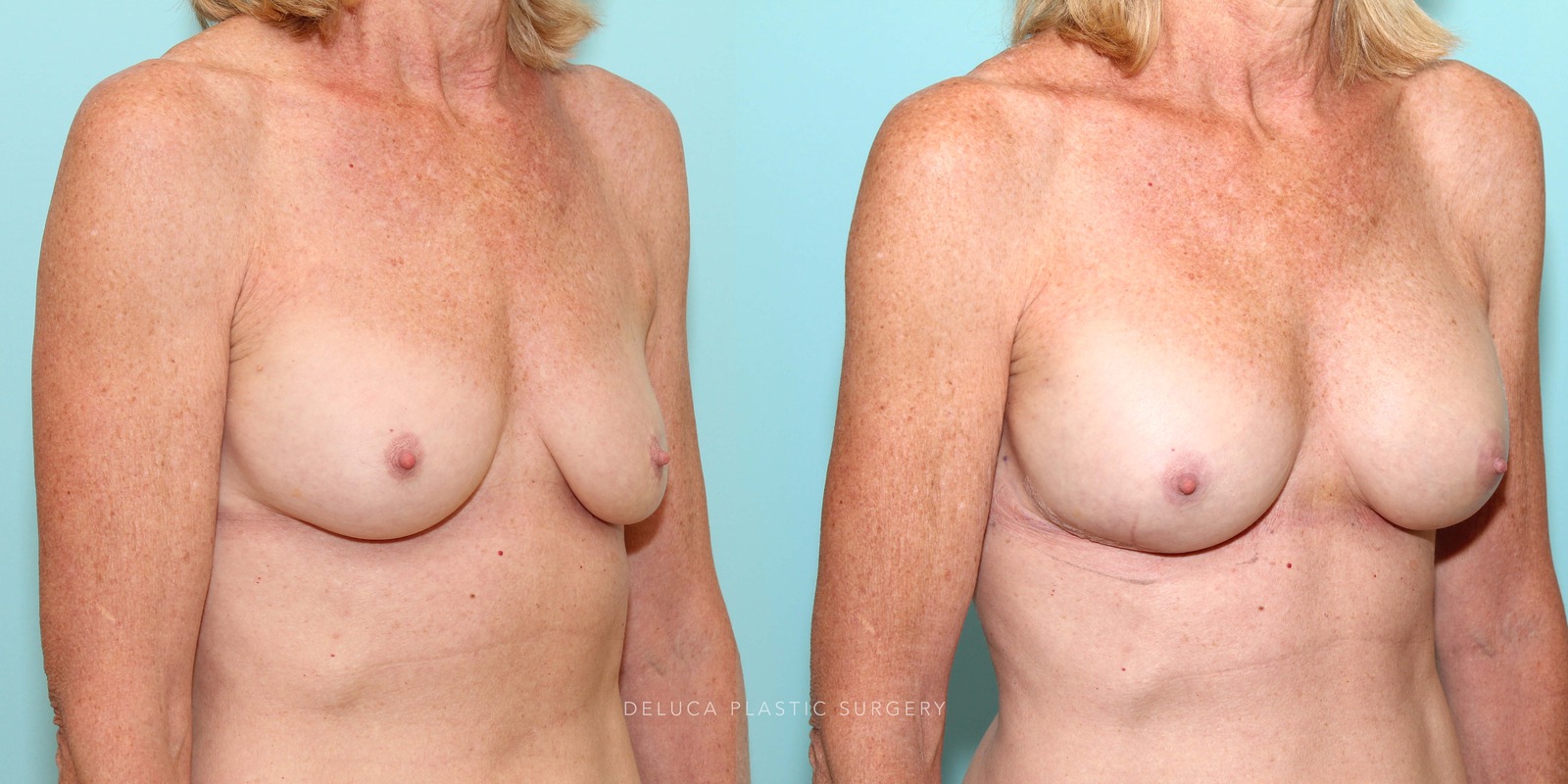 61 Year Old Secondary Asymmetric Breast Augmentation Silicone Implants