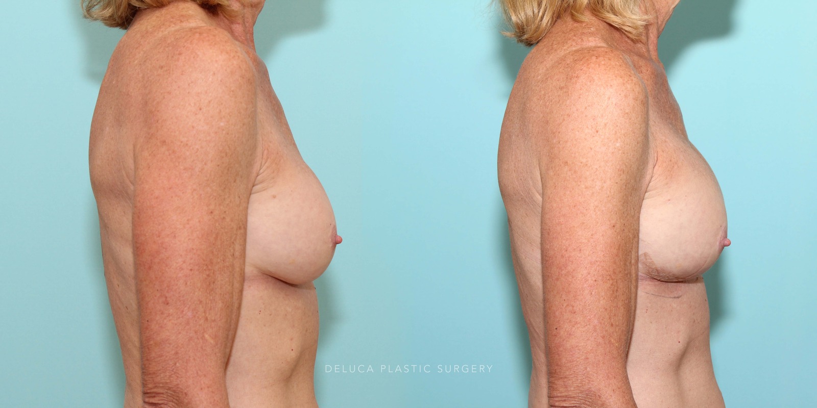 61 Year Old Secondary Asymmetric Breast Augmentation Silicone Implants