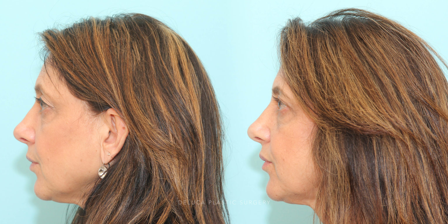 Upper Lid Pinch Blepharoplasty