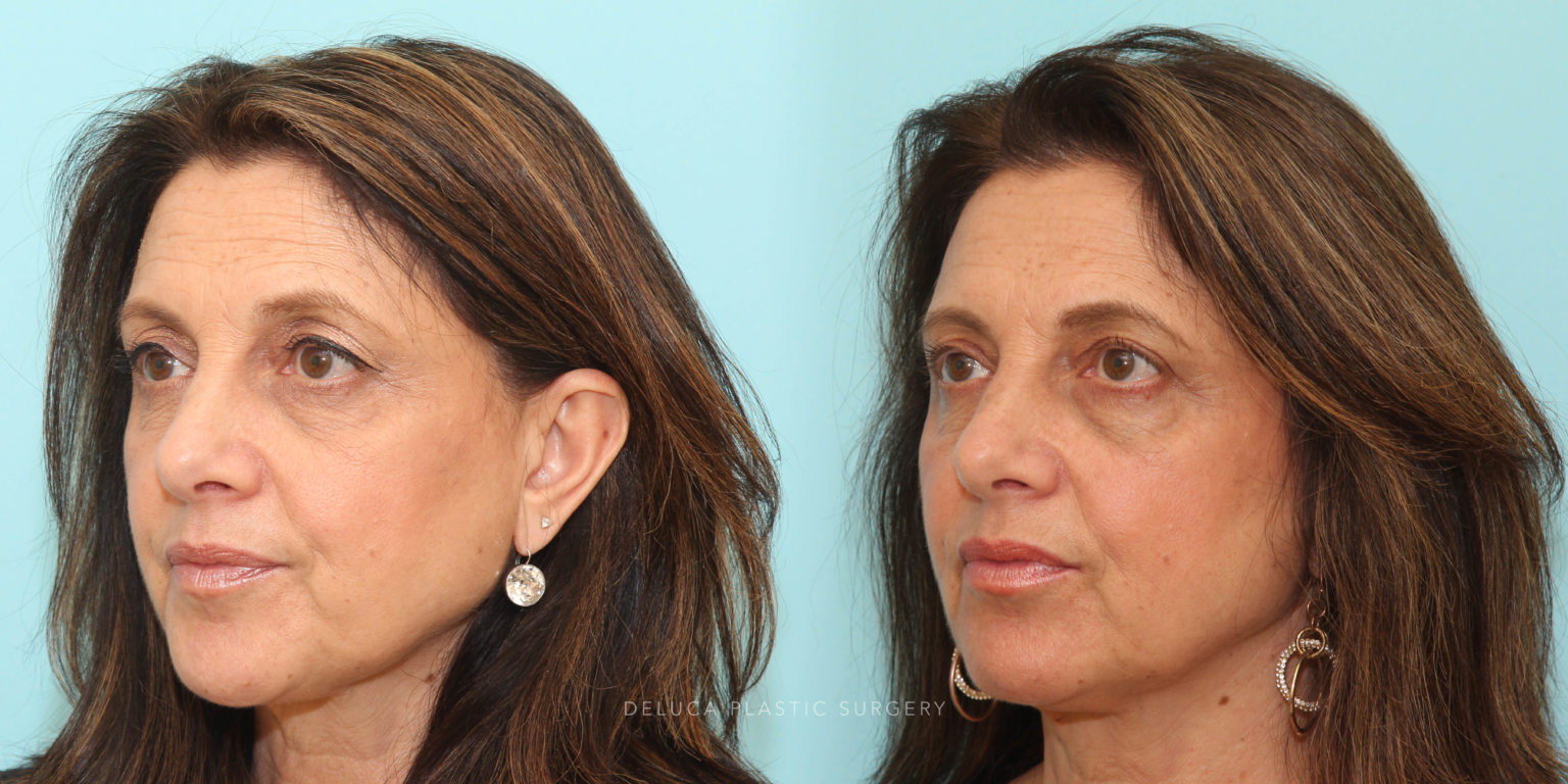 Upper Lid Pinch Blepharoplasty