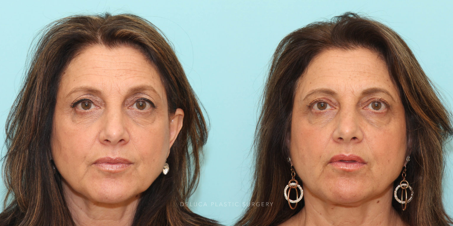 Upper Lid Pinch Blepharoplasty