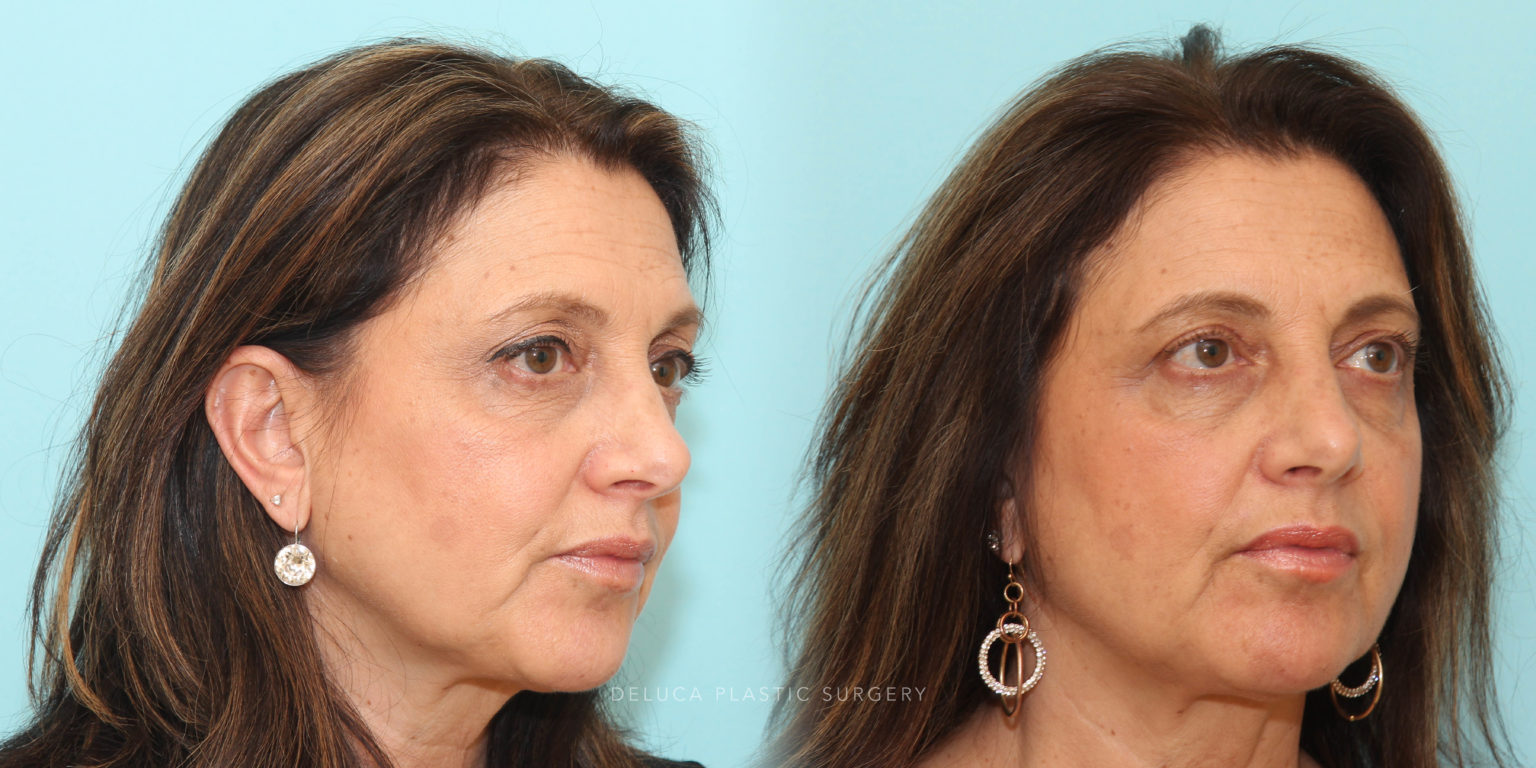 Upper Lid Pinch Blepharoplasty