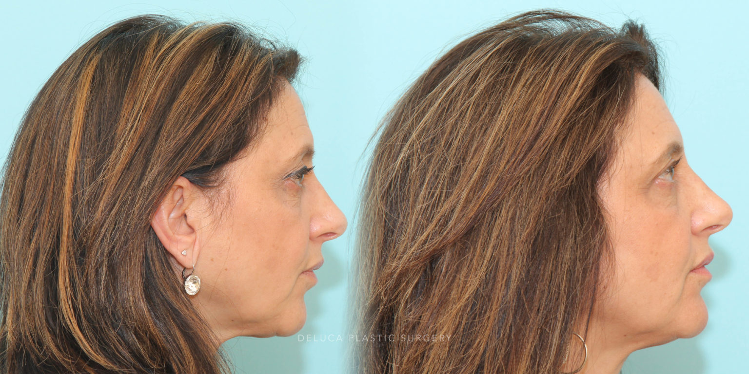 Upper Lid Pinch Blepharoplasty