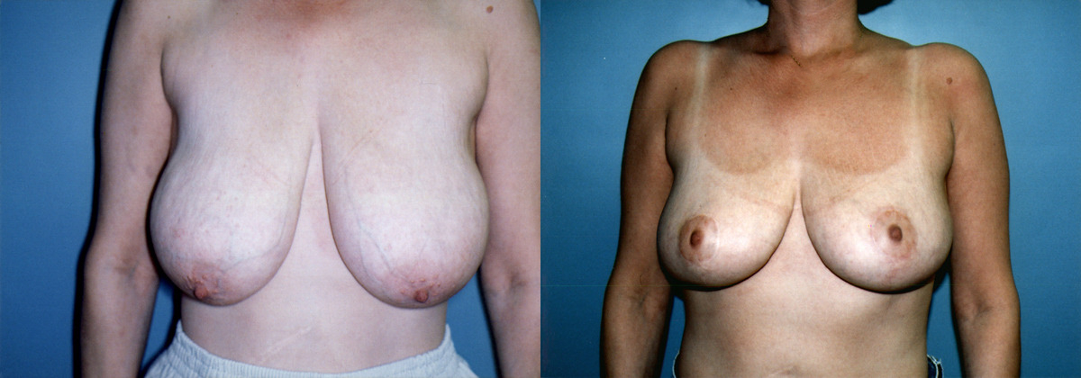 46 F Breast Reduction with Lift — before and after