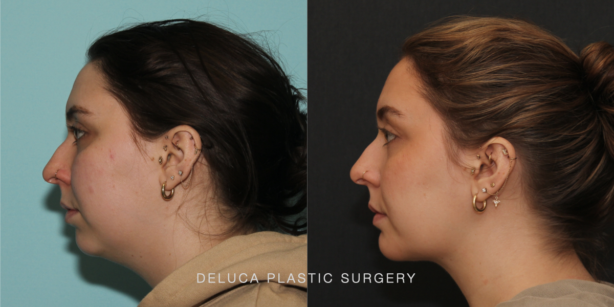 DPS Before and After 25186.001
