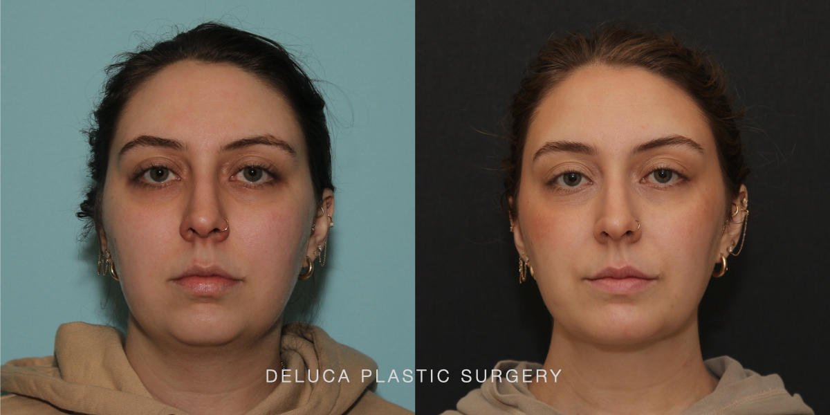 DPS Before and After 25186.003