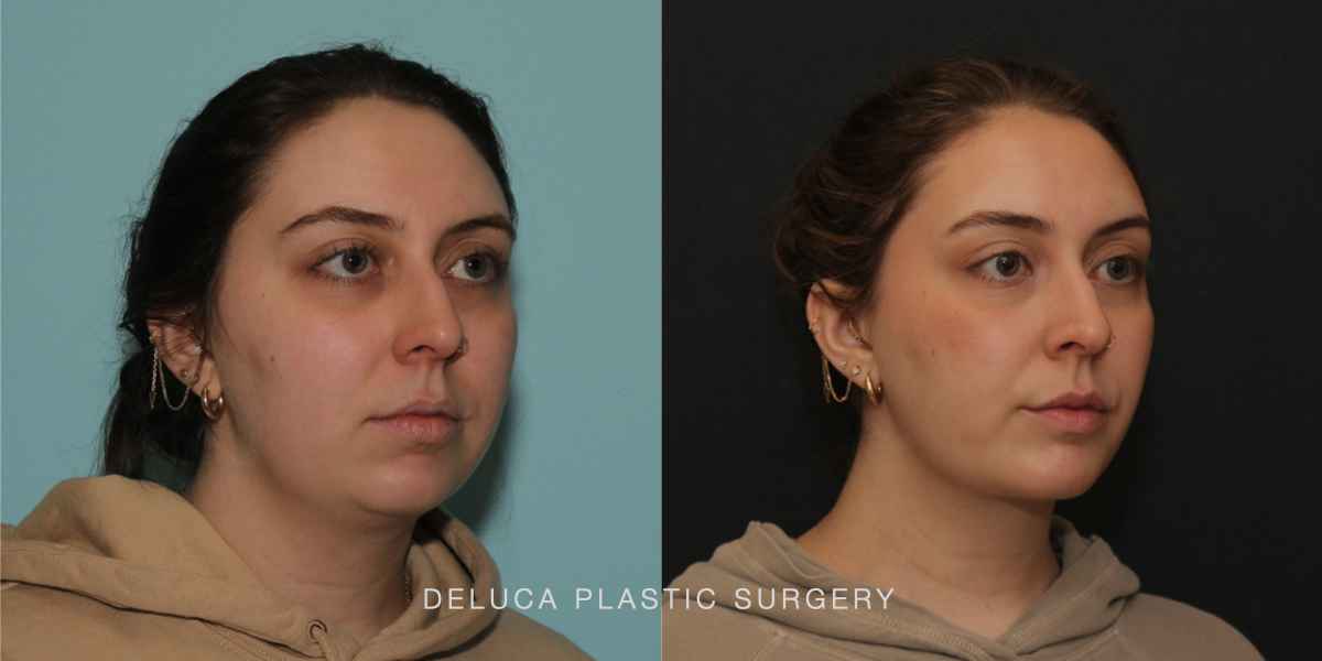 DPS Before and After 25186.004