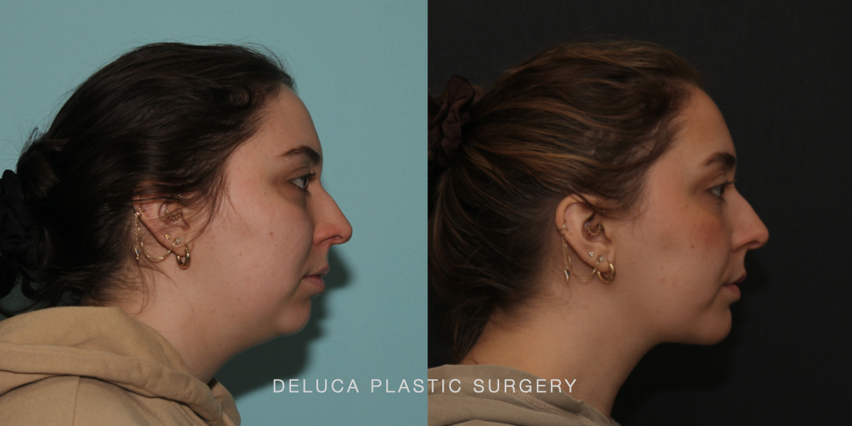 DPS Before and After 25186.005