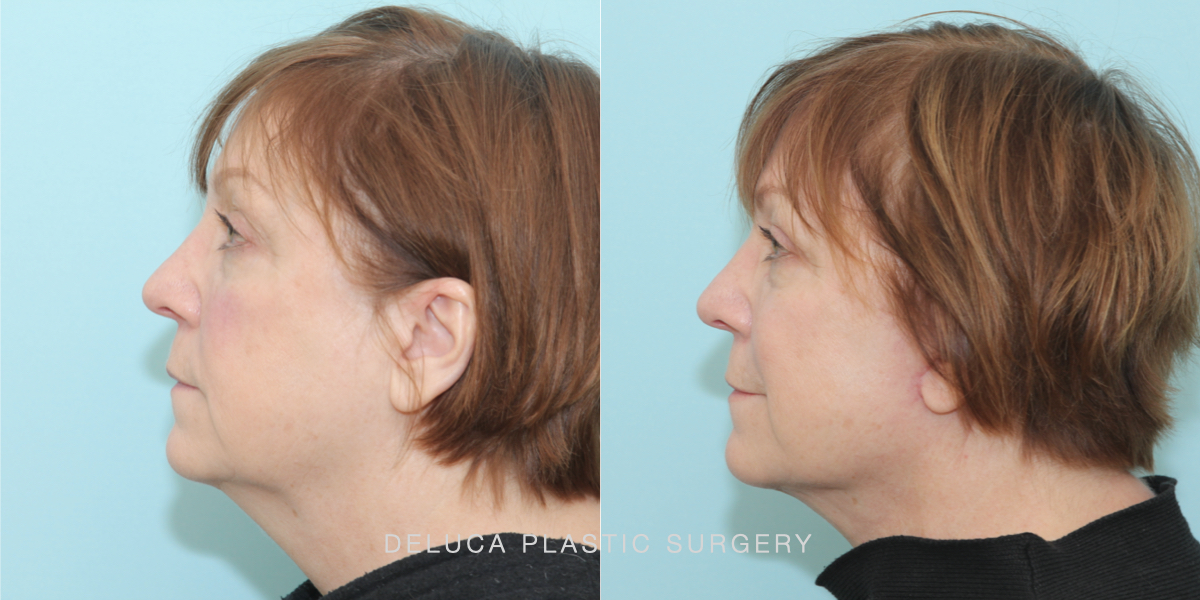 DPS Before and After 25269.001