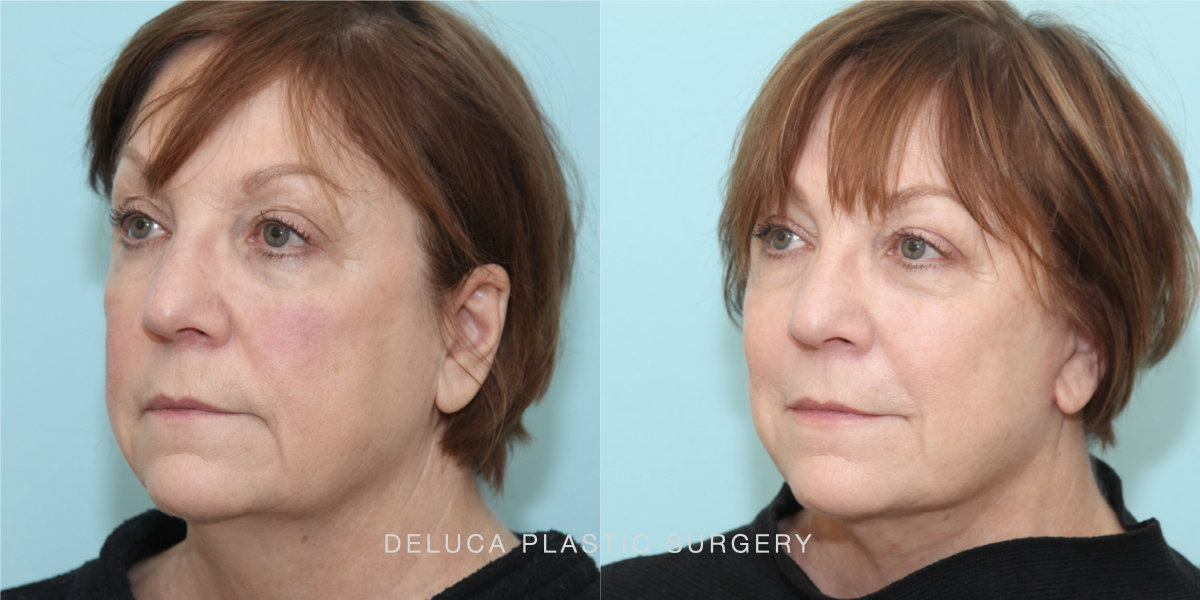 DPS Before and After 25269.002