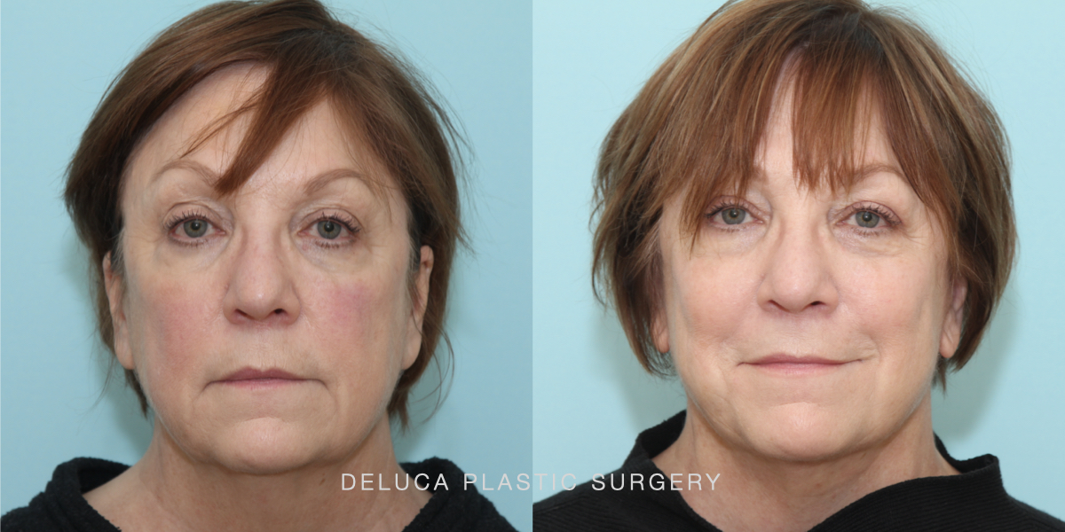 DPS Before and After 25269.003
