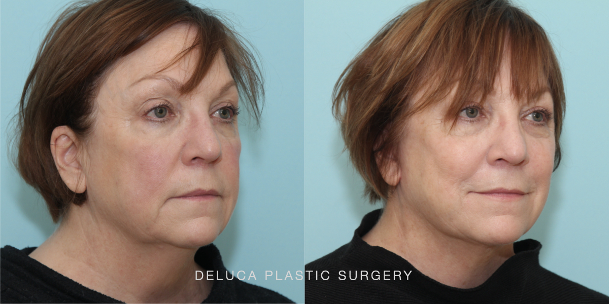 67 y/o Submental (Neck) Liposuction, Modified Mini Face and Neck Lift ...