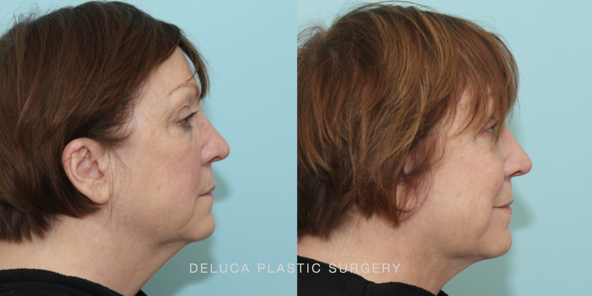 DPS Before and After 25269.005