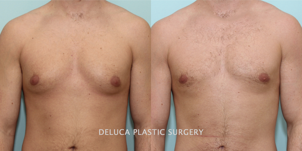 Gynecomastia surgery before and after showing improved male chest contour