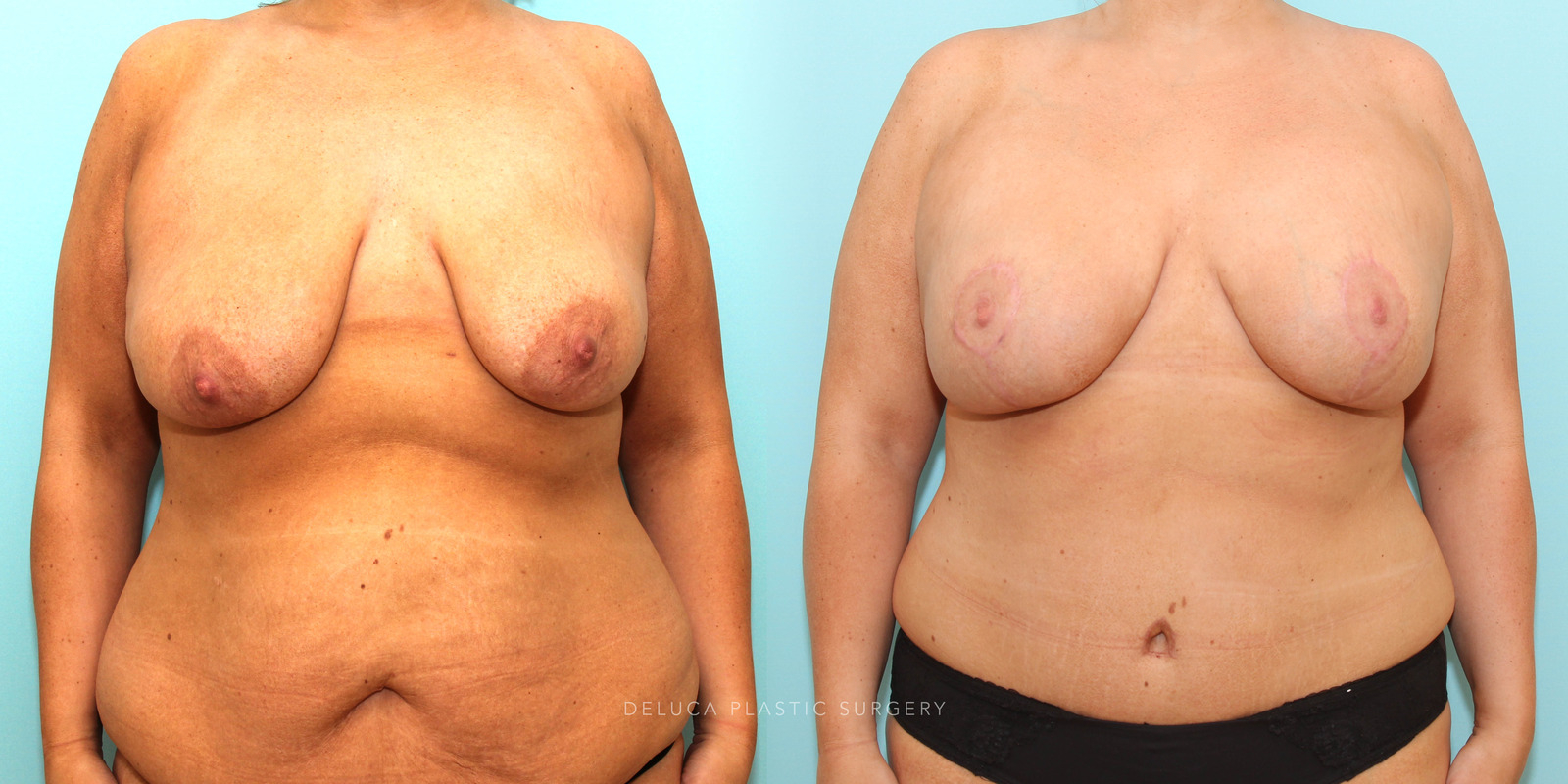34 F Mommy Makeover After Twins and Weight Loss — before and after