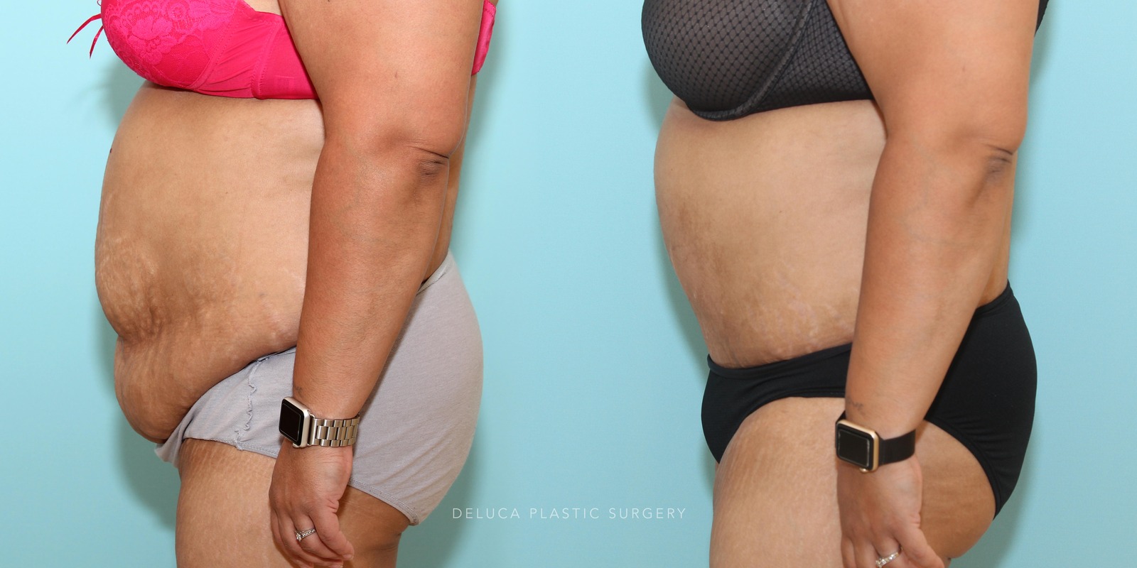 39 year old Tummy Tuck (Abdominoplasty)