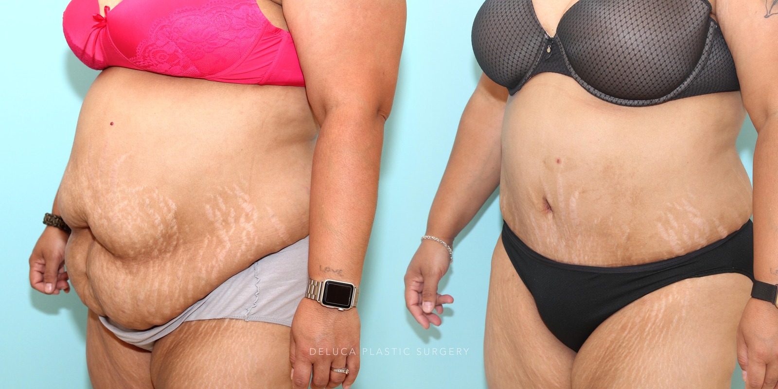 39 year old Tummy Tuck (Abdominoplasty)