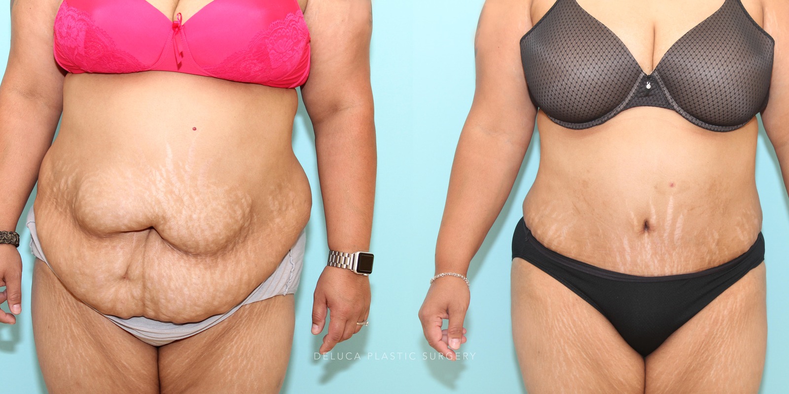 39 year old Tummy Tuck (Abdominoplasty)