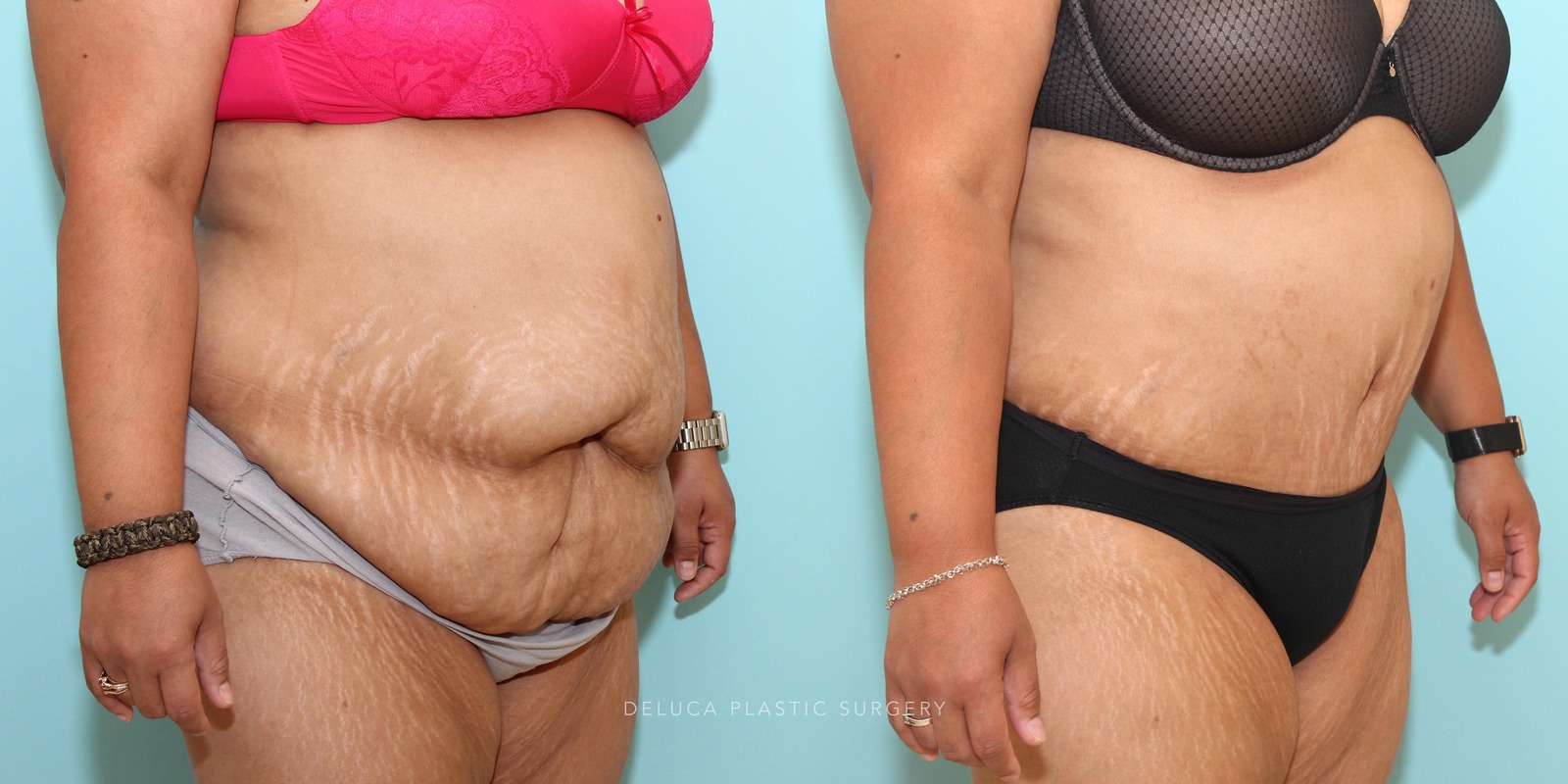 39 year old Tummy Tuck (Abdominoplasty)