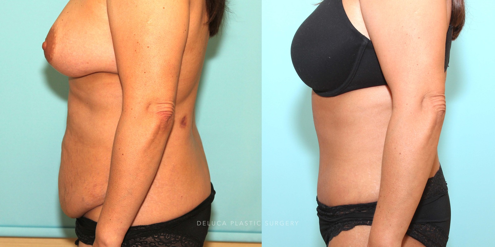 48 year old Tummy Tuck (Abdominoplasty)